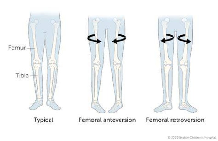 Can femoral anteversion cause pain