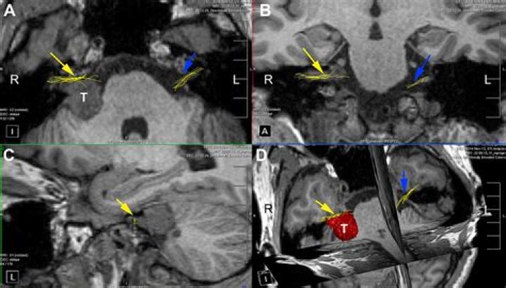Can MRI show cranial nerve damage