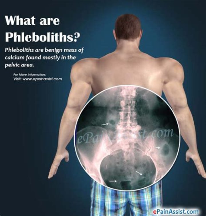Can Phleboliths be dangerous