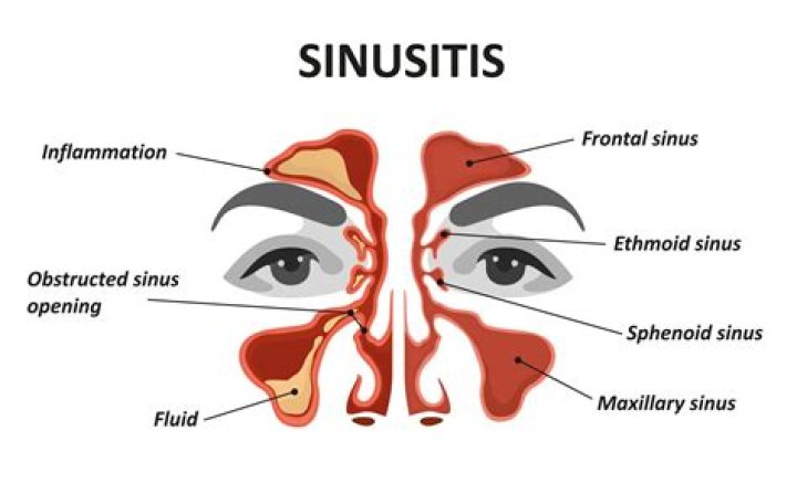Can sinuses cause cavities