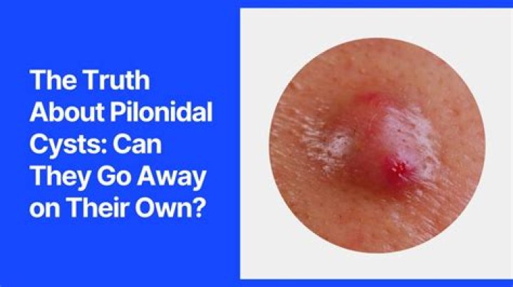 Can you get a cyst on your perineum