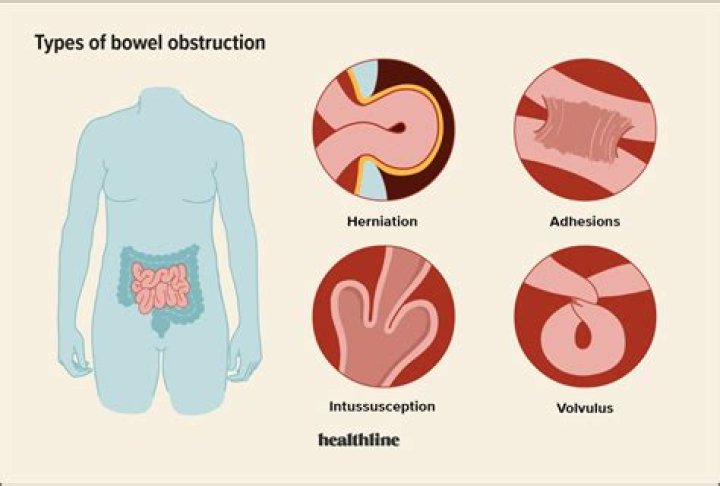Can you have diarrhea with a bowel obstruction