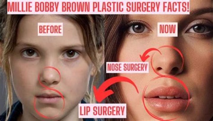 
How Did Millie Bobby Brown Look Before And After Plastic Surgery? 