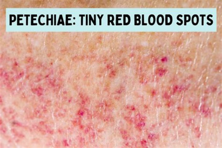 How do you test for petechiae