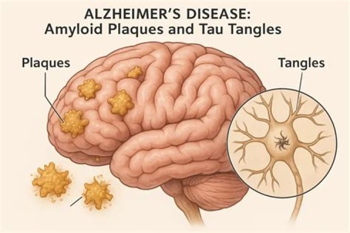 How does amyloid plaques cause dementia