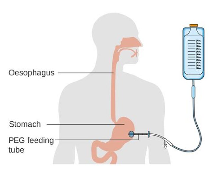 Is a PEG feeding tube painful