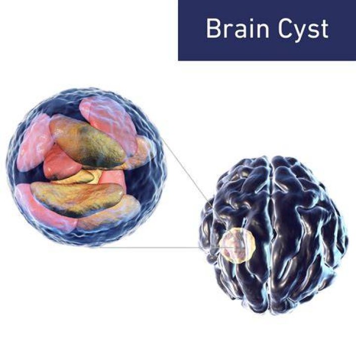 What causes cysts on the brain