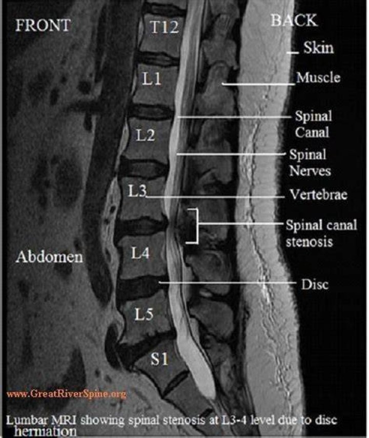 What is a MRI spine lumbar and sacral