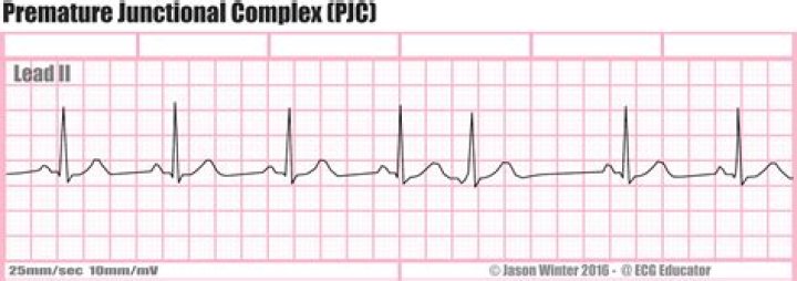 What is a premature junctional rhythm