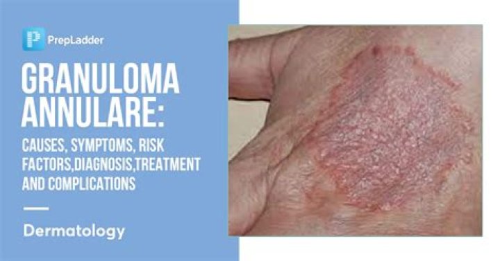 What is granuloma annulare caused from