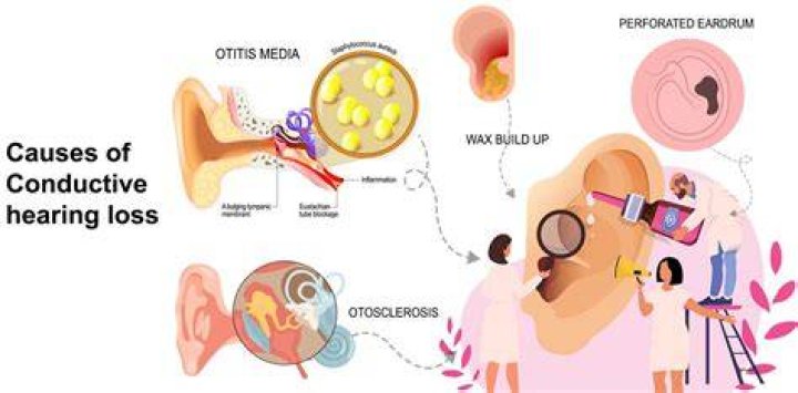 What is the most common cause of conductive hearing loss quizlet