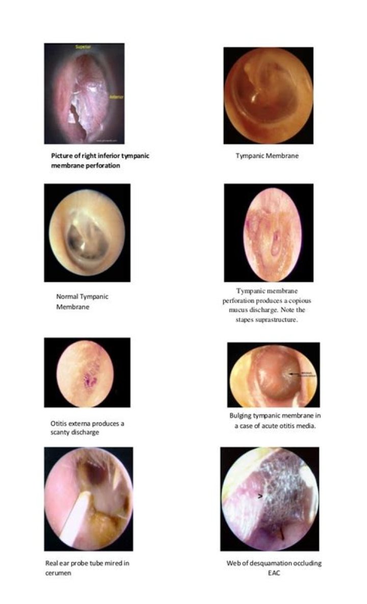 What is tympanic membrane disorder