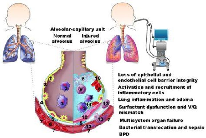 What is ventilator induced lung injury